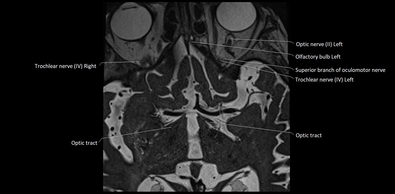 Cranial nerve anatomy axial MRI 3T image 5.webp